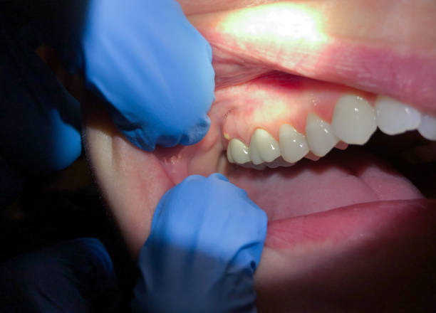 Best Lost Filling or Crown Replacement in Brooksville, MS